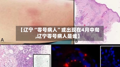 【辽宁“零号病人”或出现在4月中旬,辽宁零号病人是谁】