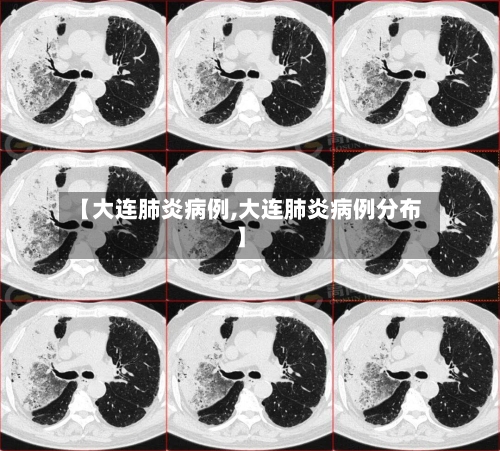 【大连肺炎病例,大连肺炎病例分布】